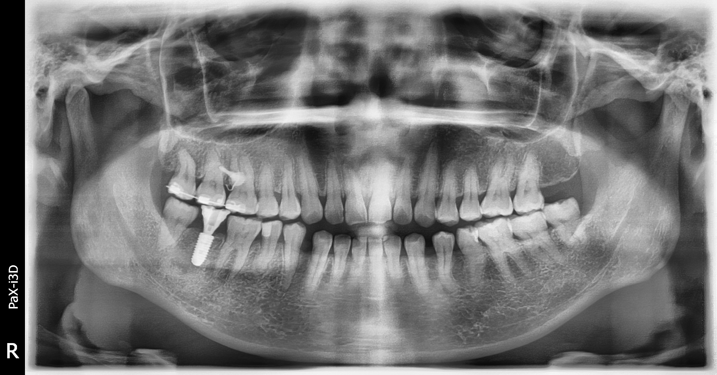 Vatech PaX-i3D SC – Máy toàn cảnh + Ceph + CBCT nha khoa đã qua sử dụng