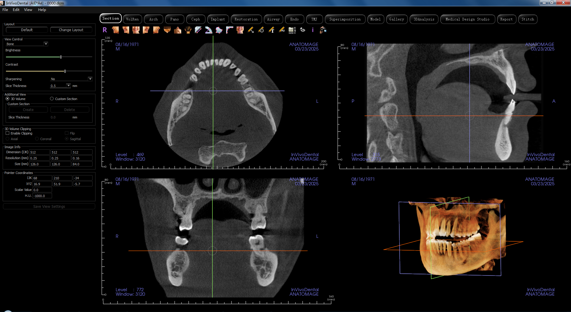二手CBCT菲森Dentrix 20 CBCT