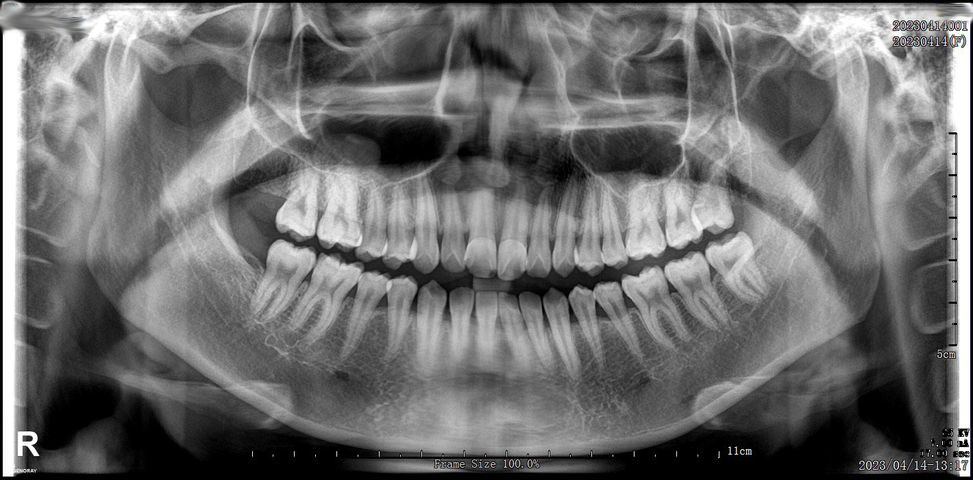 Genoray PAPAYA Plus Máy Chụp X-quang Nha Khoa Toàn Cảnh + Sọ Nghiêng Đã Qua Sử Dụng