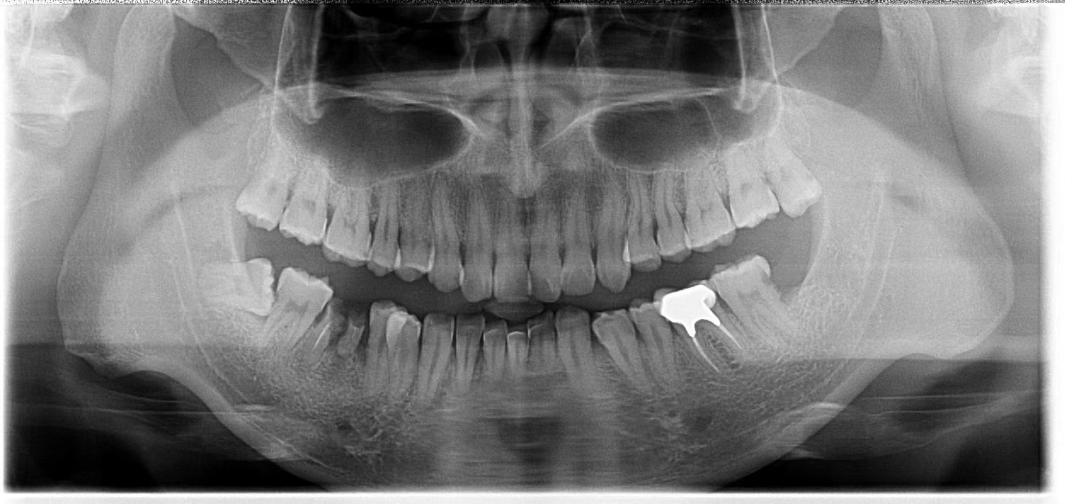 Carestream CS9300 Dental Pano+Ceph+CBCT System Used Dental CBCT