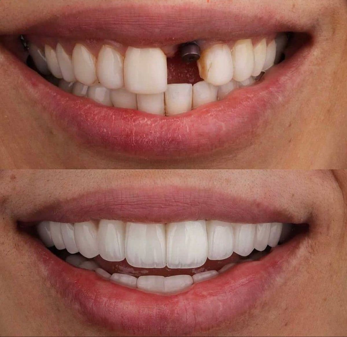 Implantes dentários