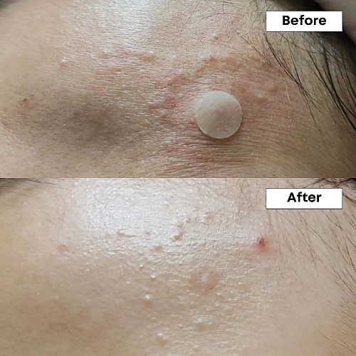 Nineless A-Control 10% Azelaic Acid Serum 