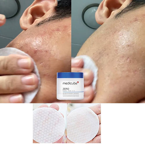 medicube Zero Pore Pad 2.0 70P
