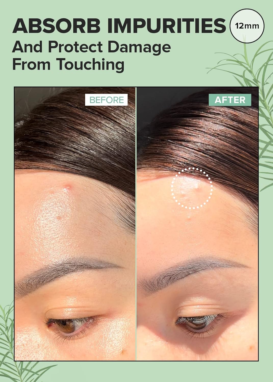 I DEW CARE Hydrocolloid Acne Pimple Patch - Timeout Blemish Plus 36 Count (12mm)