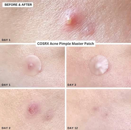 COSRX Acne Pimple Master Patch (3ea X 24 patches)