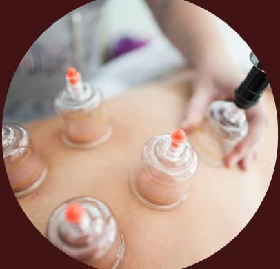 Acupuncture Cupping Service