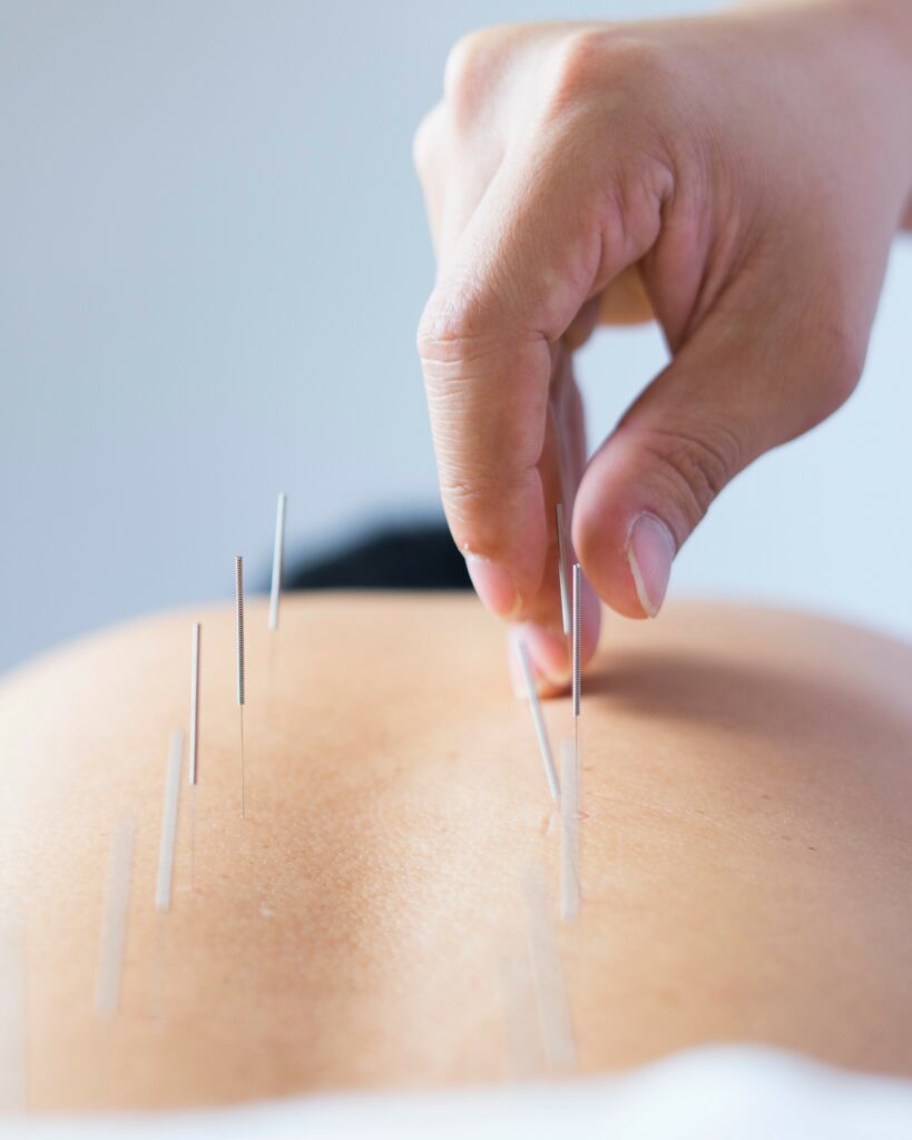 Agulhas para acupuntura Han Bang 0,25mm x 15mm com 1000 unidades