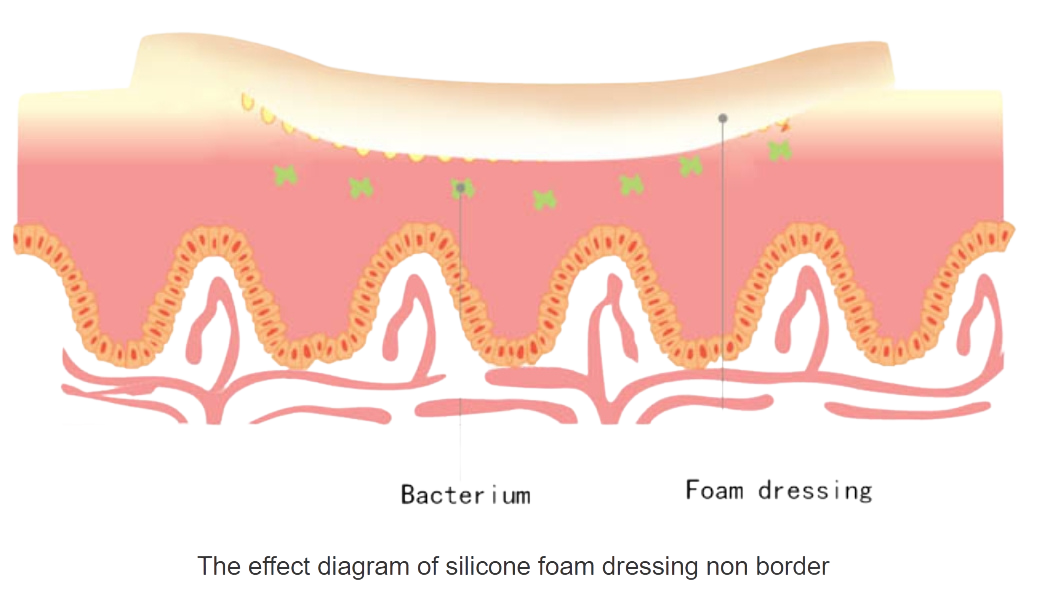 Foam Dressing