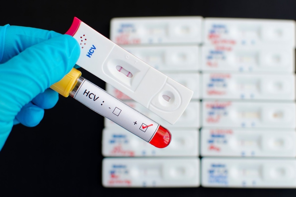 Hepatite C HCV