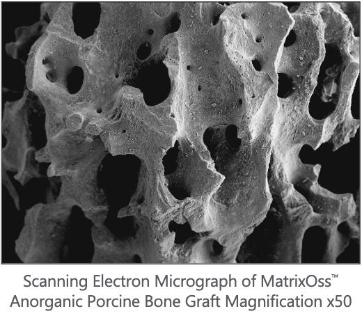 Xenoinjerto Dental MatrixOss® Granules