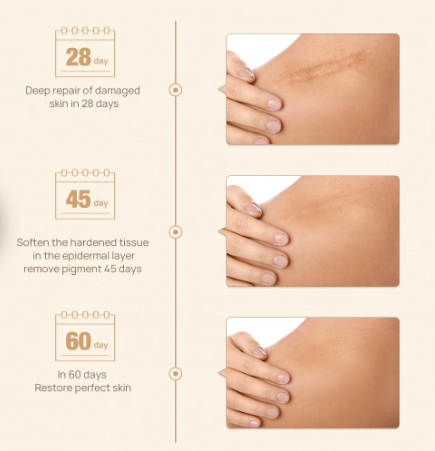 LANBENA Herbal Acne Scar Removal Stretch Marks Cream Skin Repair Nigth Cream