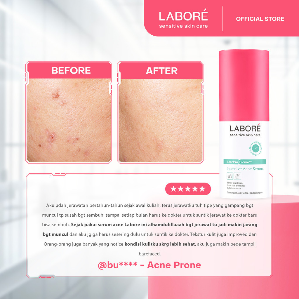 Serum Intensif Kulit Wajah Berjerawat