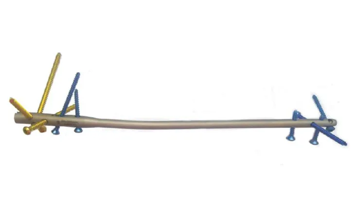  Clavo de tibia multiacerrojado