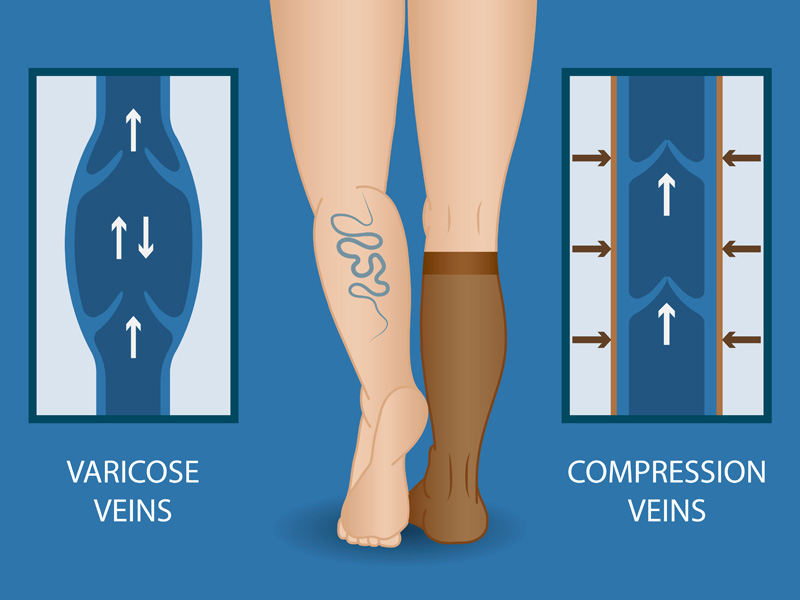 Beige Knee High Compression Stockings (Ortho-Aid Brand)