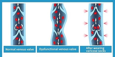 Black Thigh High Compression Stockings(Ortho-Aid Brand)