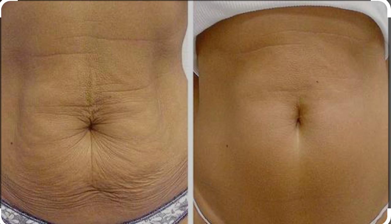 Skin Tightening -  50 minutes session (5)