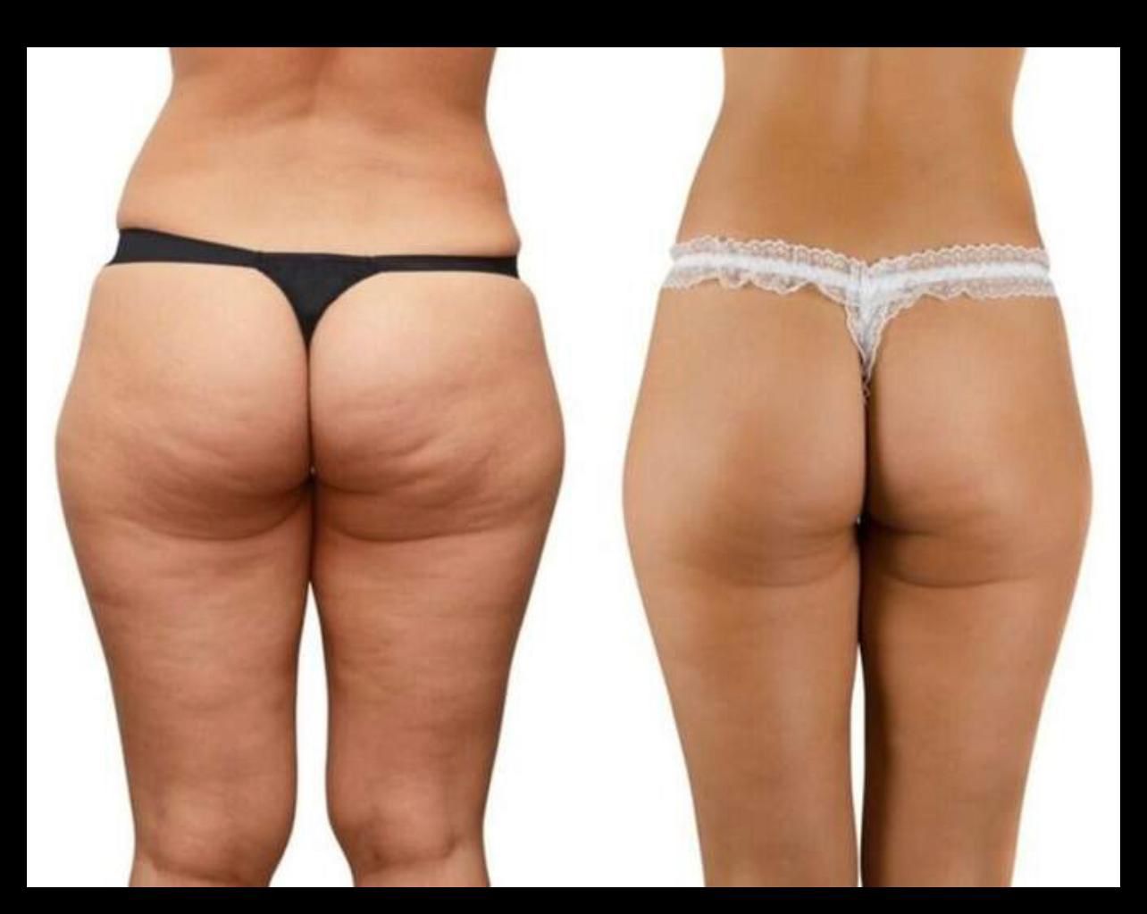 Cellulite Reduction -  50 minutes session (5)