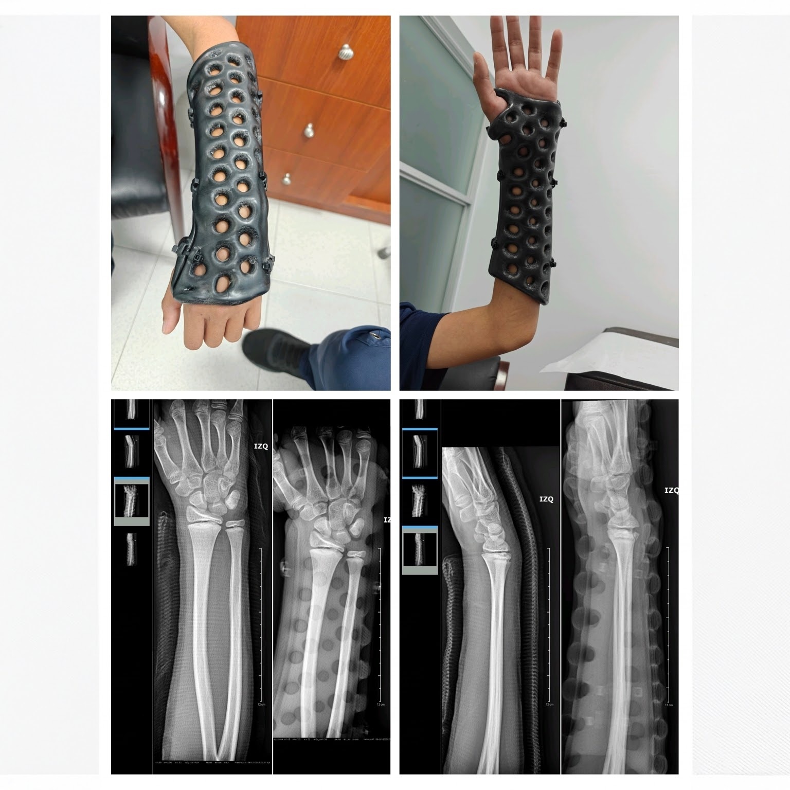 3D Printed Arm Cast