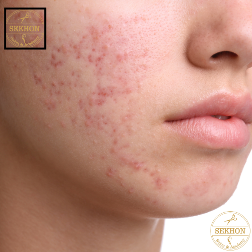 Acne Treatment 