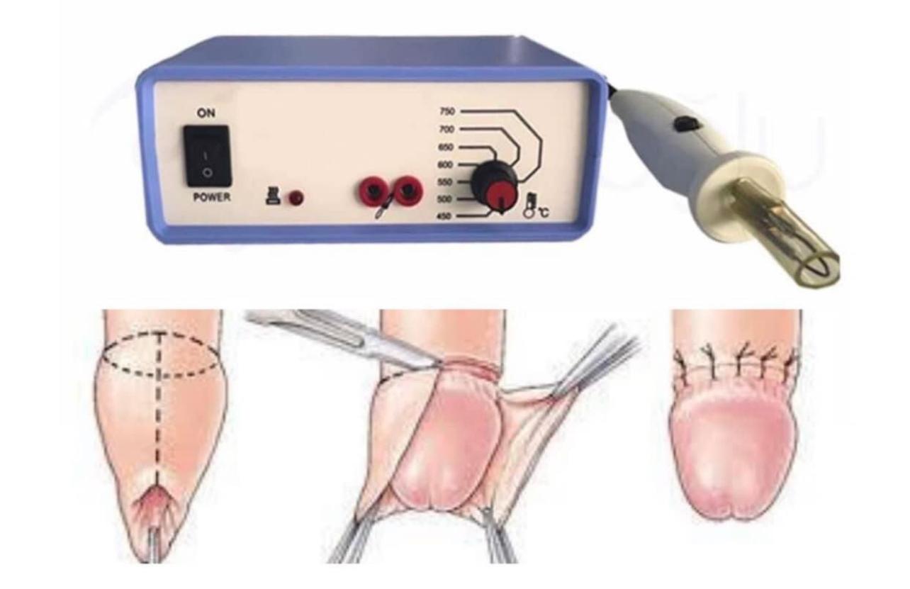 Medical Circumcision  Device