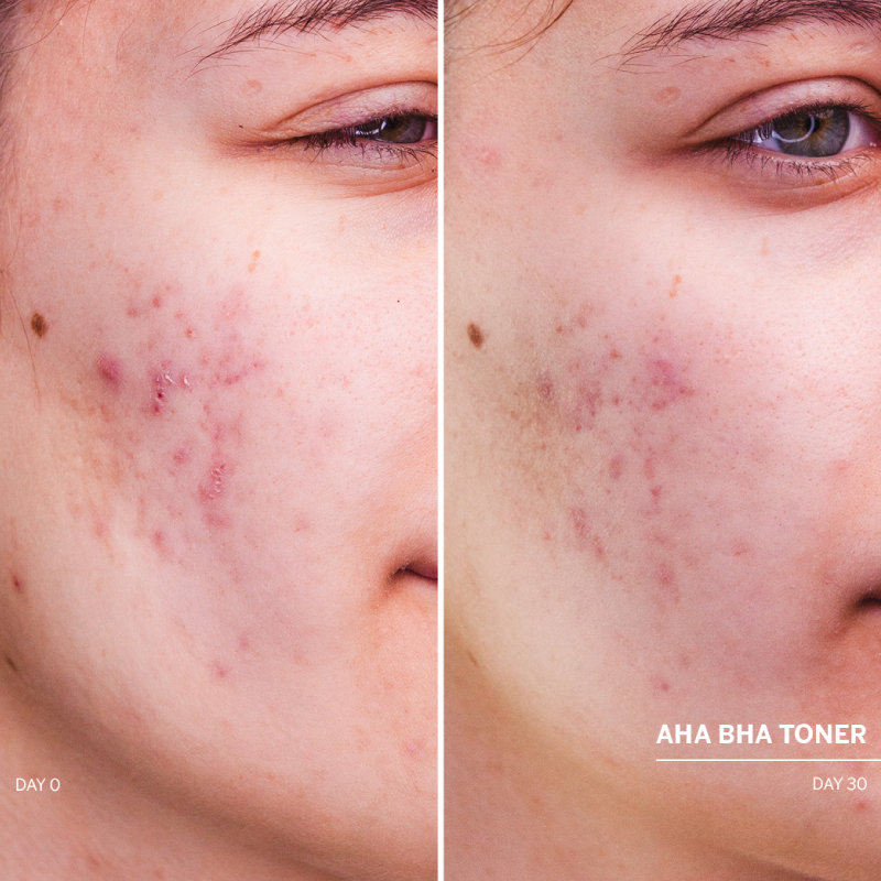 Odos atsinaujinimą skatinantis veido tonikas su rūgštimis. AHA BHA Toner