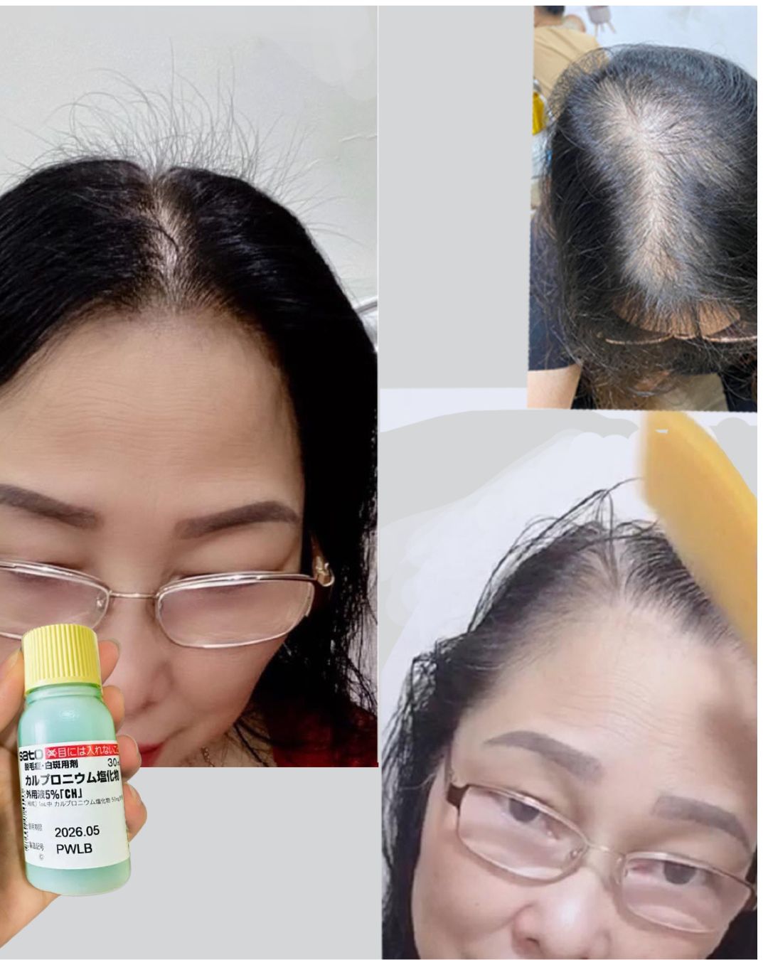 Sato Carpronium Chloride Solution 5% 30ml Hair Fall Tonic Made In Japan 30ml