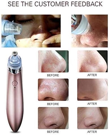  Blackhead Remover vacuum