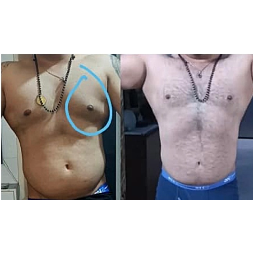 Gyno Cure Chest Shaper | Cure Reverse Gyno Quickly |Website For Wholesale Orders- Amazon For Retail Orders