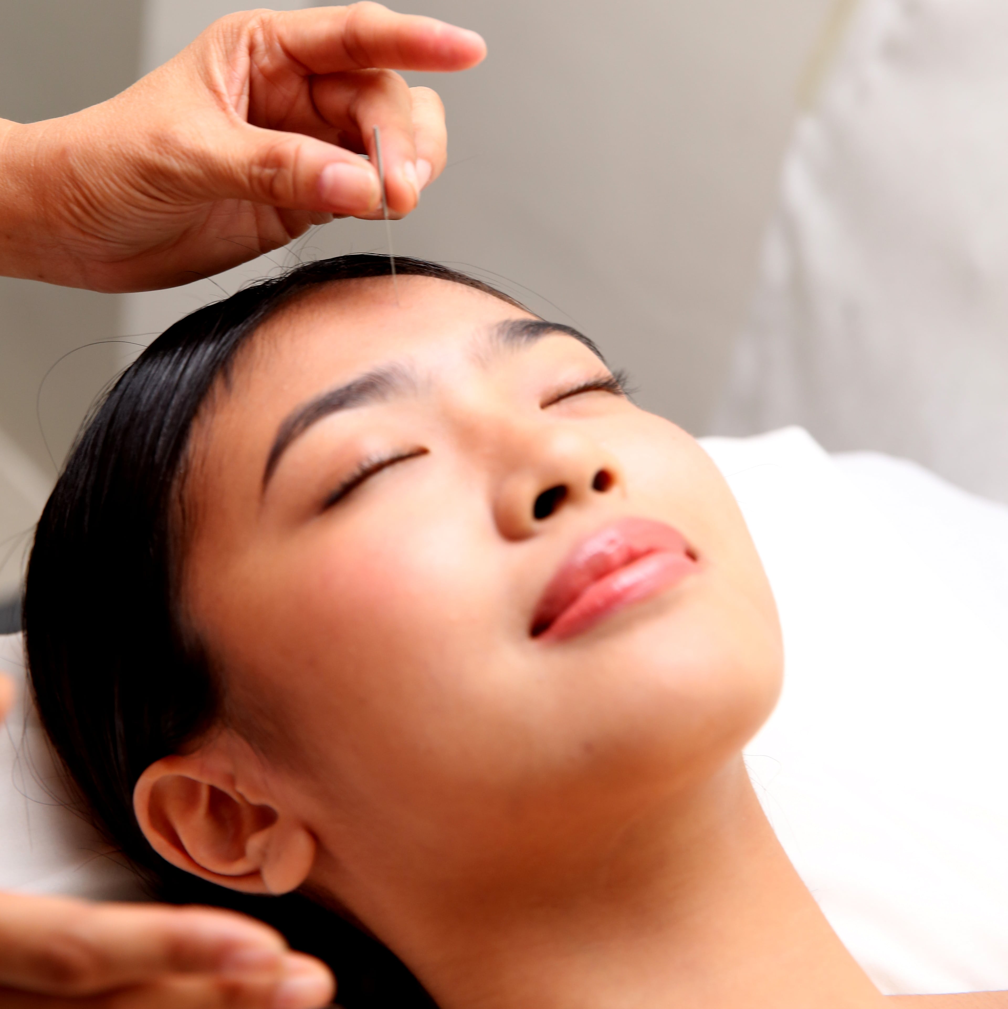 Acupuncture