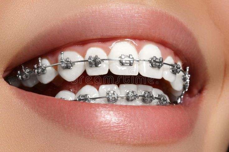 BRACES DP