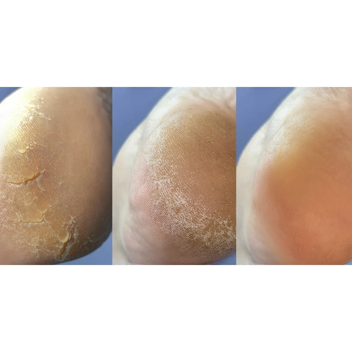 Nailsoftheday Podology+ Anti-crack cream for feet and hands, urea 12%, 30 ml