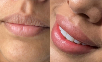 Neutralización de Labios