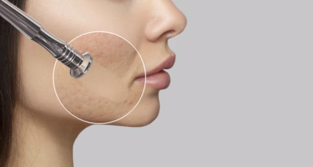 💎 The Diamond-Tip Microdermabrasion: Face Only