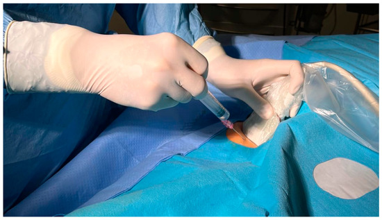 Groin Ultrasound (Post-Procedure Check)
