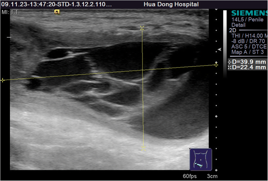 Groin Ultrasound (Post-Procedure Check)