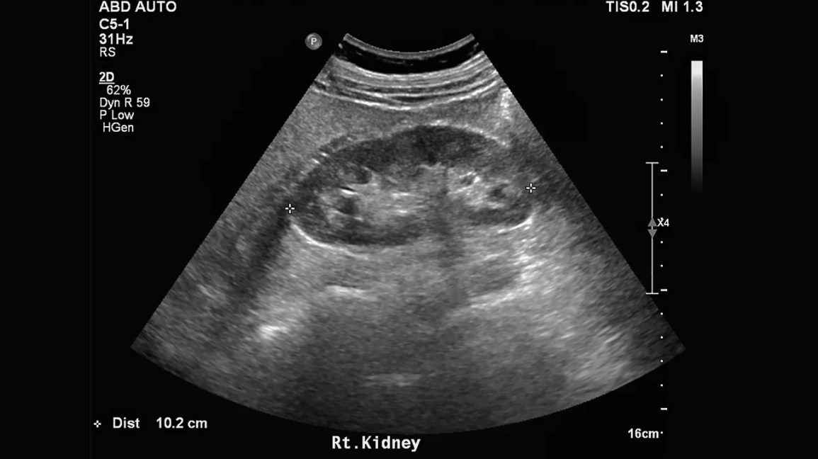 Renal / Kidney Ultrasound