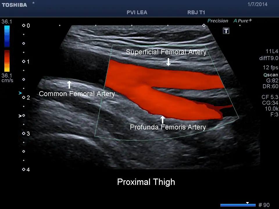Upper & Lower Extremity Arterial Ultrasound – Leg & Arm Arteries