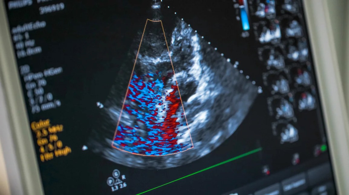Echocardiogram (Echo Test) – Heart Ultrasound