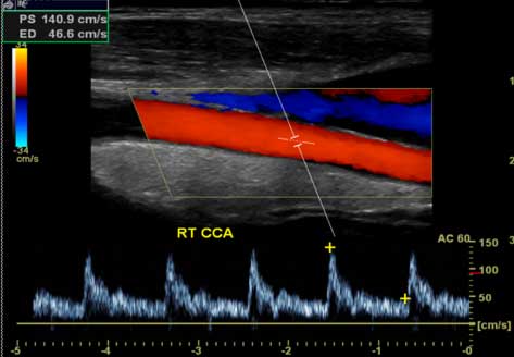 Carotid Ultrasound – Neck Artery Scan