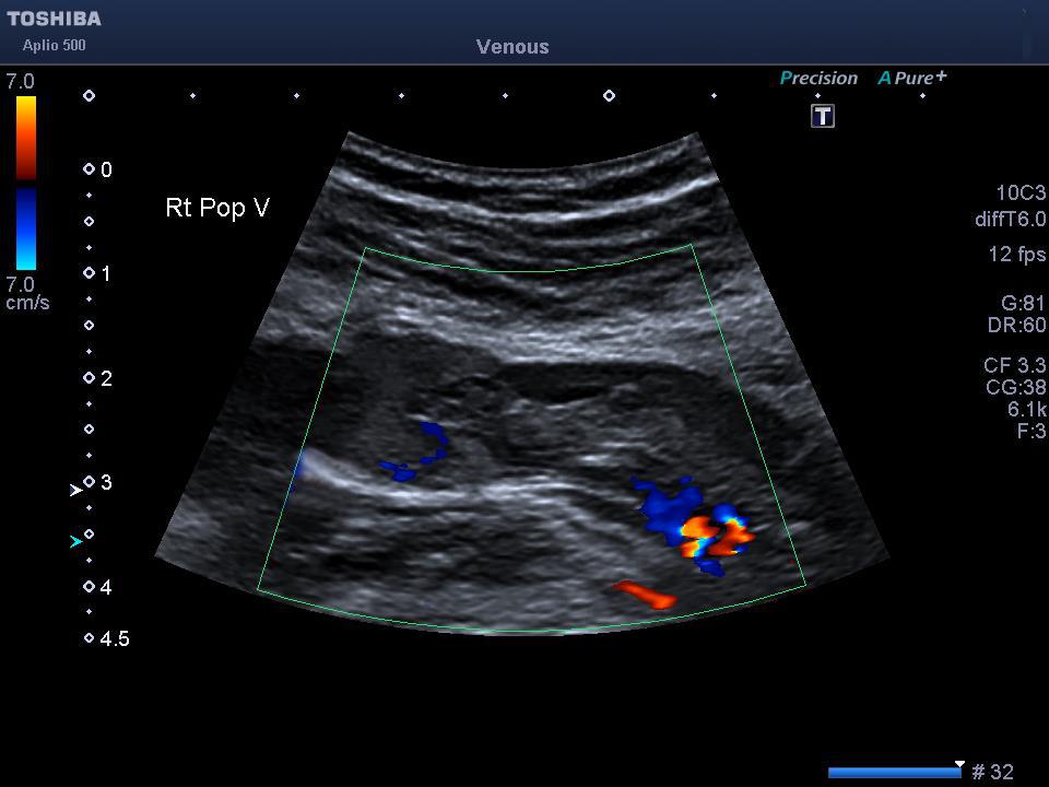 Upper & Lower Extremity Venous Ultrasound – Vein Scan
