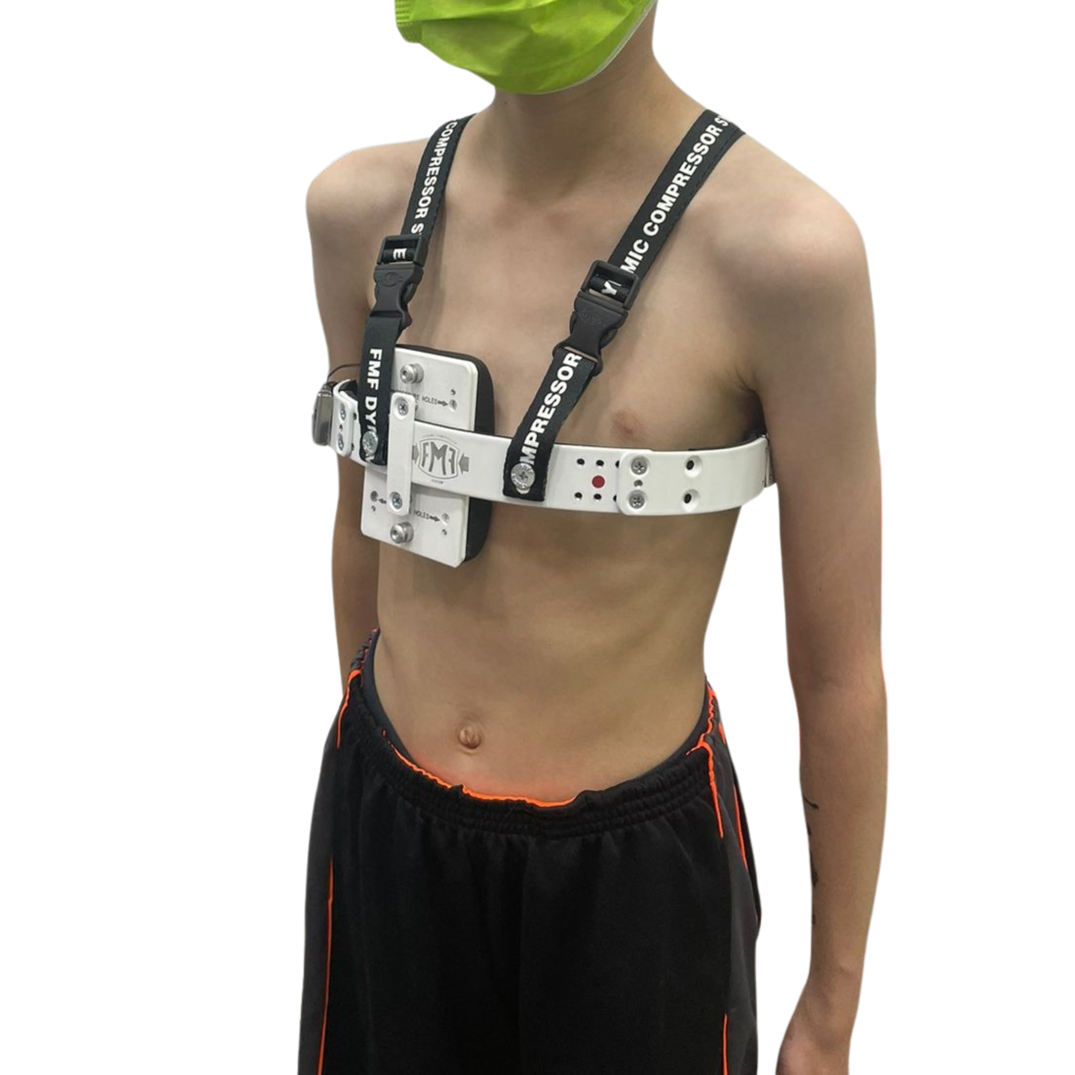 Sistema Compresor Dinámico FMF – Corrector No Quirúrgico de Pectus Carinatum