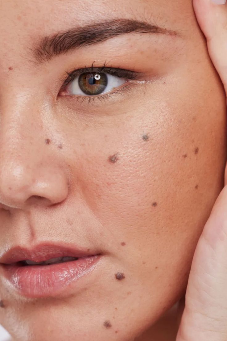Facial Marks ( Spot, Mole, Tag, तिल e.t.c. )