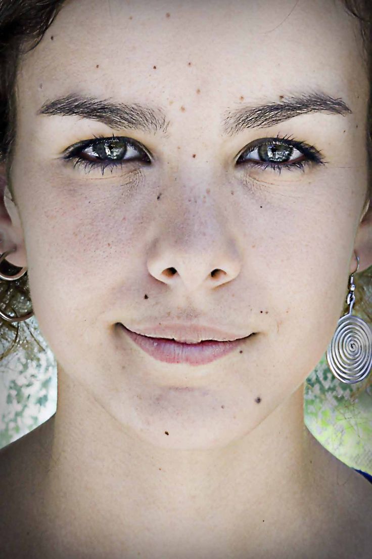 Facial Marks ( Spot, Mole, Tag, तिल e.t.c. )