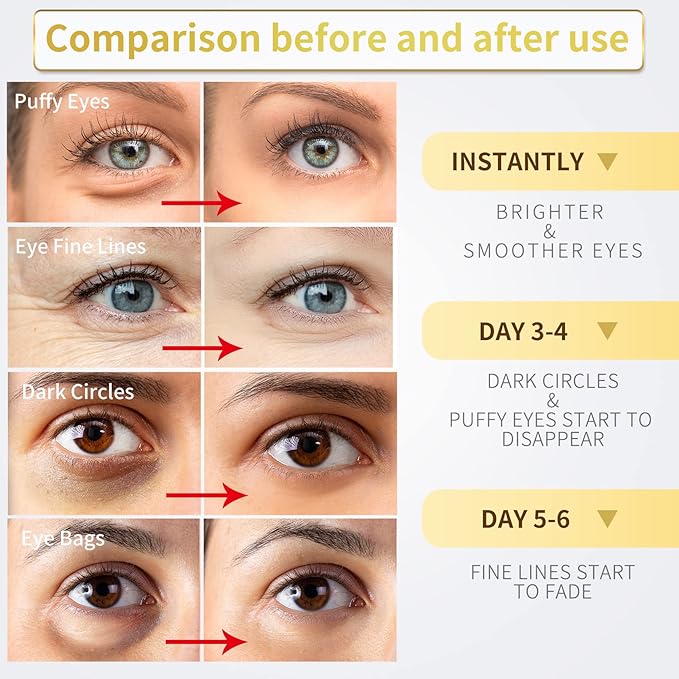 Under Eye Patches for Dark Circles and Puffiness 