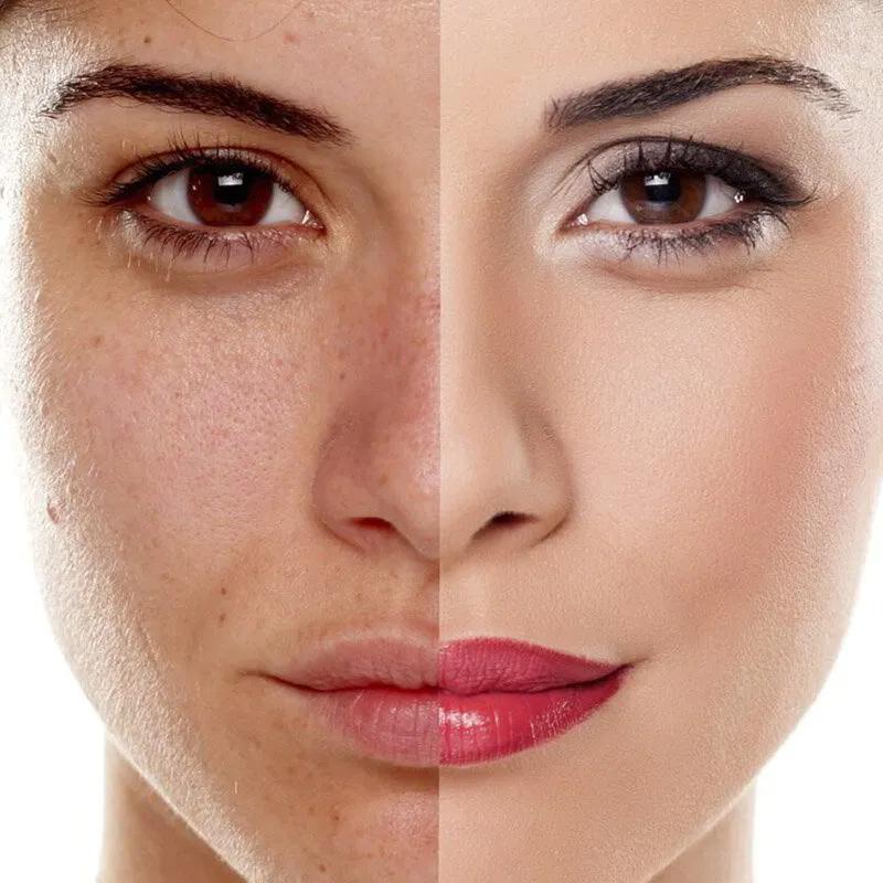 Tratamientos Faciales Tratamiento Despigmentante