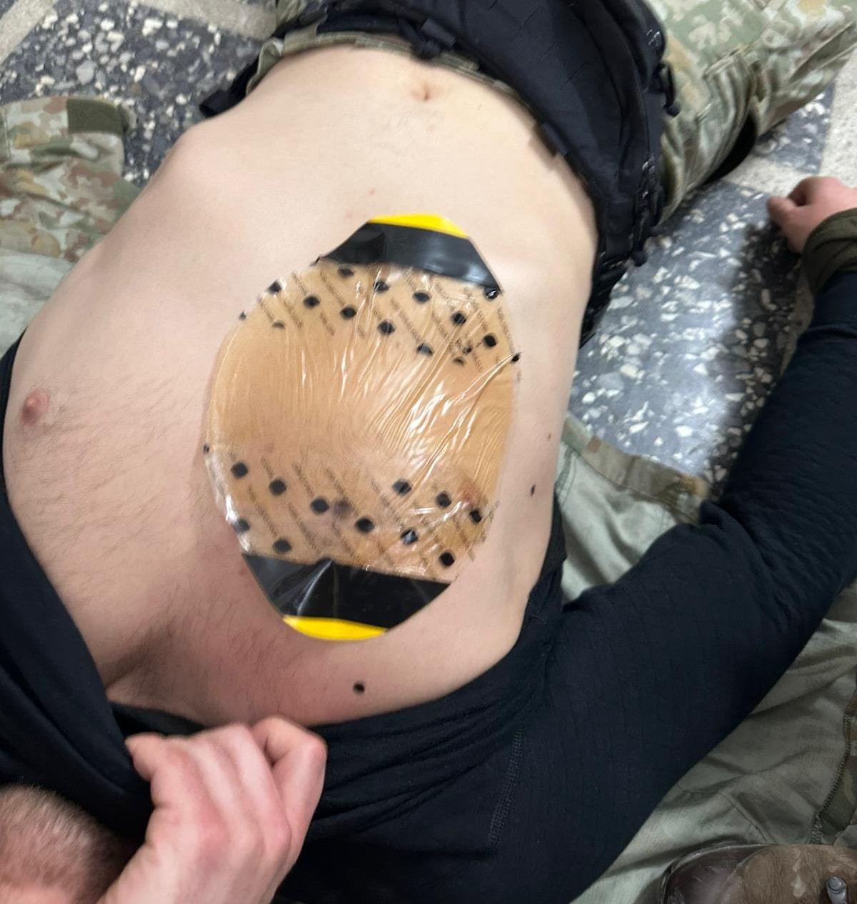  SAM Okliuzinis Krūtinės Tvarstis