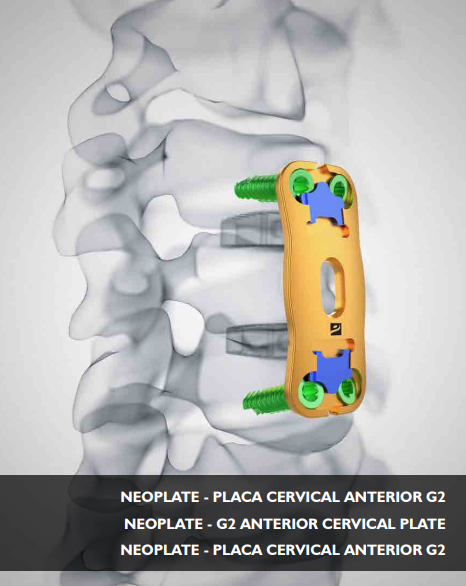Placa Cervical Anterior G2