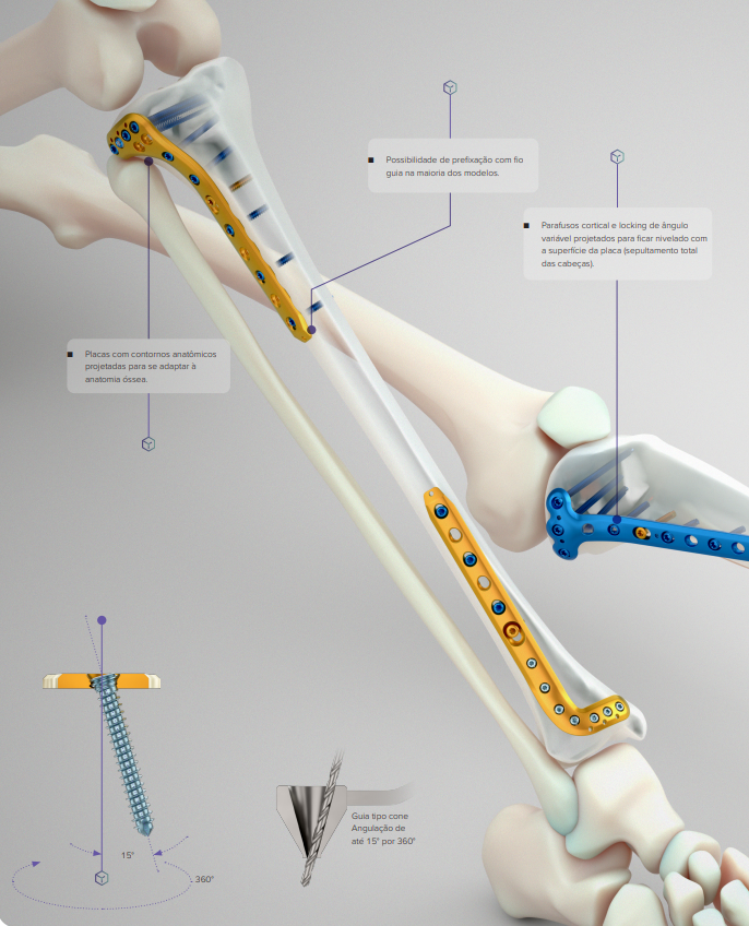 Placa de Pequenos Fragmentos para Membros Inferiores