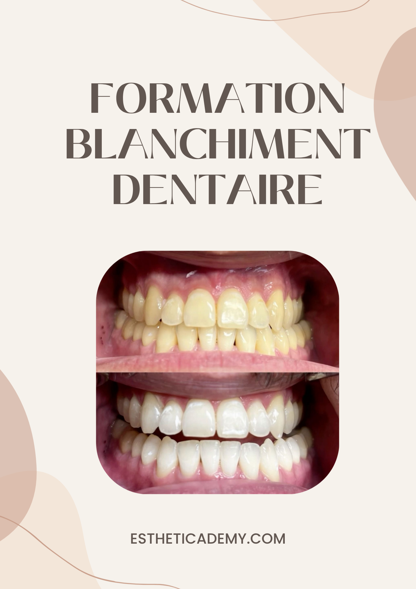 Formation Blanchiment Dentaire