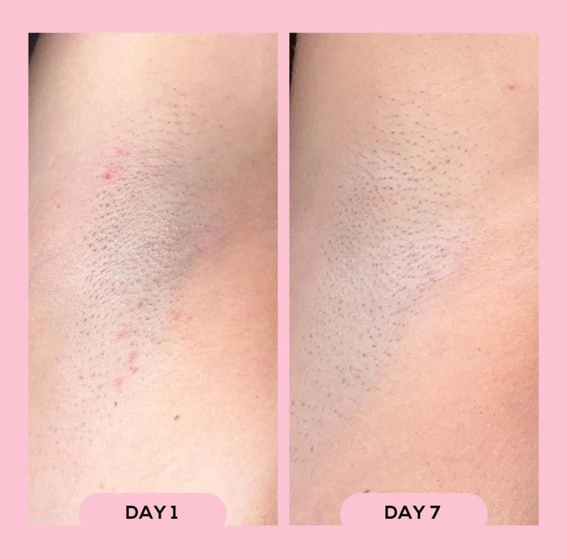 Después de afeitado y depilacion